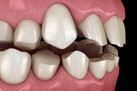Was bringt das Tragen einer Zahnschiene?